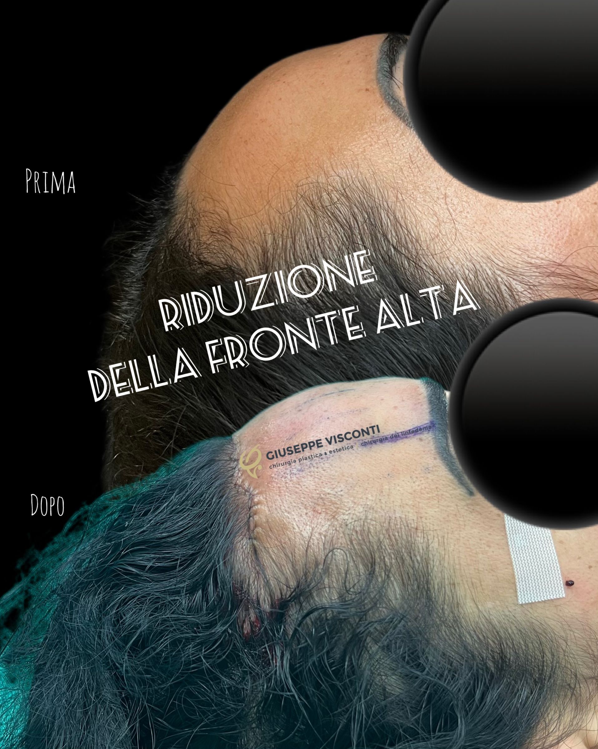 fronte alta