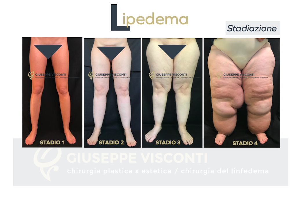 lipedema